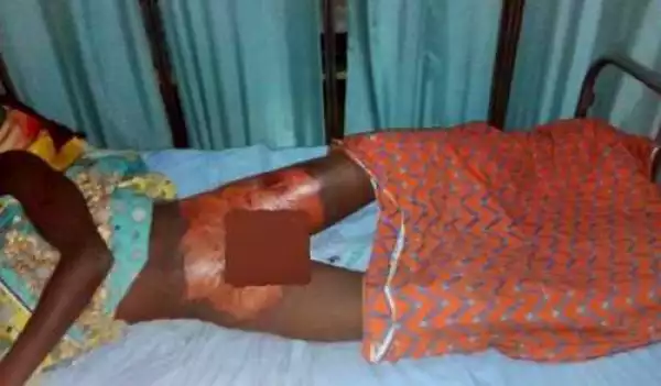 See Photo of the Teenage School Boy Whose Manhood was Burnt by an Angry Couple in Sokoto